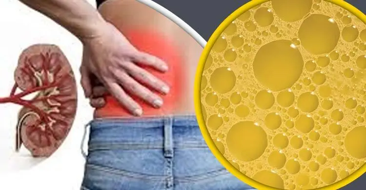 প্রস্রাবে অতিরিক্ত ফেনা কি কিডনি বিকল হওয়ার লক্ষণ?